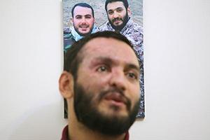 صورت زیبای این جوان با 150 ترکش!