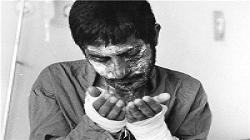 پای درد و دل 60 هزارجانباز شیمیایی