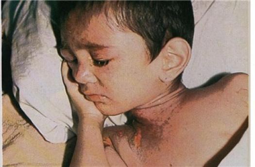 جانباز شیمیایی سردشتی؛ ۲۸ سال با درد دست‌و‌‌پنجه نرم می‌کند